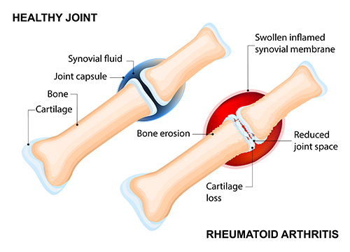 Rheumatoid arthritis of the wrist inflammation and pain