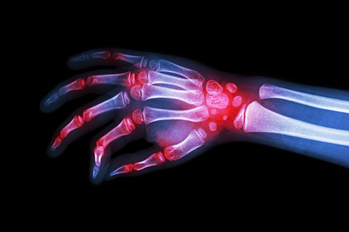 Rheumatoid arthritis inflammation in the wrist and joints wrist supports