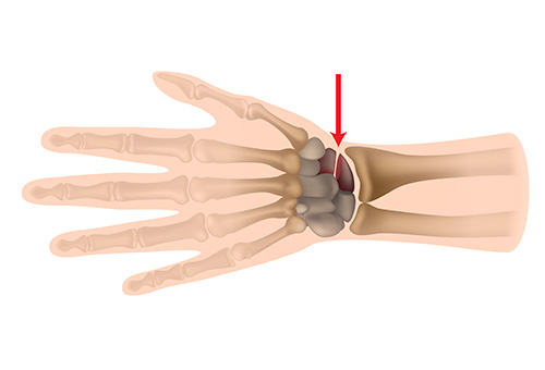 Scaphoid Fracture