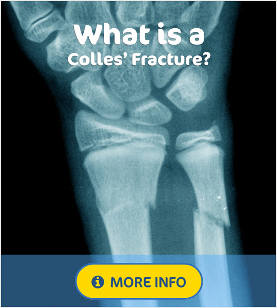 What is a Colles' fracture?
