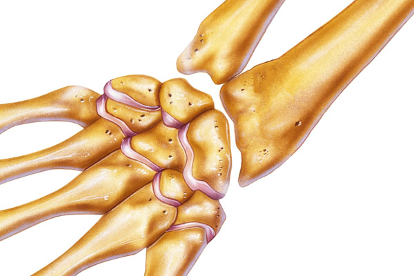 What is Chronic Wrist Irritation?