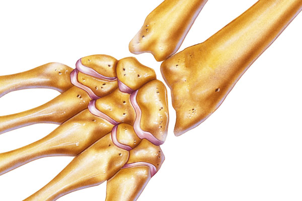 What is a Wrist Fracture?