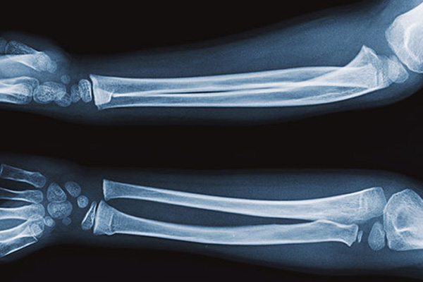 bone buckle