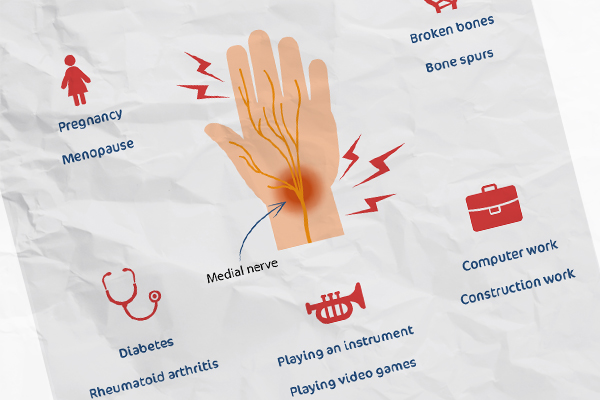 Carpal Tunnel Syndrome Infographic