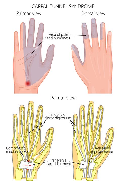 Carpal Tunnel Syndrome