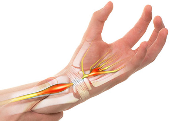 What is Carpal Tunnel Syndrome?