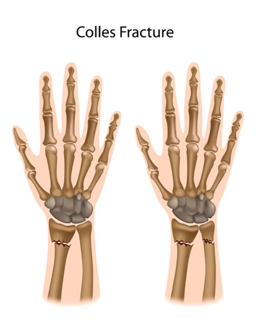 Colles' fracture of the radial bone