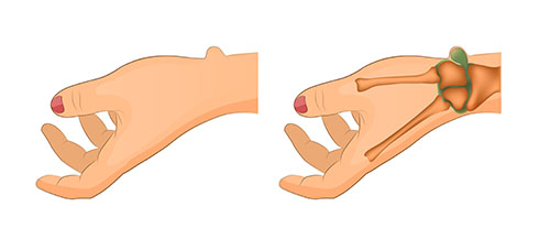 Ganglion Cyst Diagram