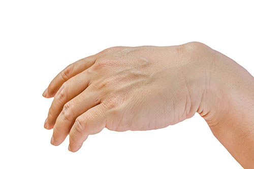 A Ganglion Cyst On The Wrist