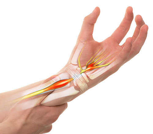 Pain in the hand from carpal tunnel syndrome