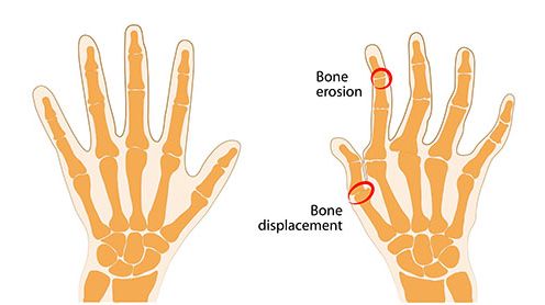 What is Ulnar Deviation? - WristSupports.co.uk What is Ulnar Deviation? - WristSupports.co.uk