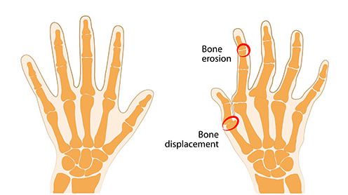 Ulnar deviation to the fingers and wrist