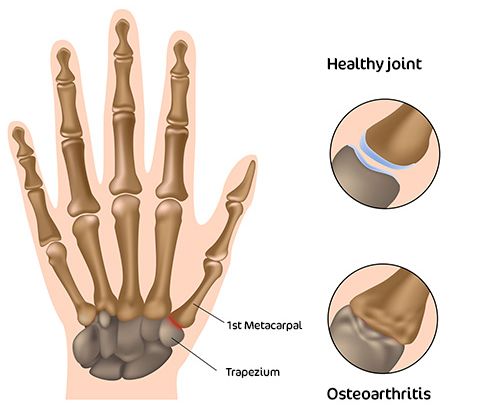 CMC Arthritis Affects The 1st CMC Joint At The Thumb Base