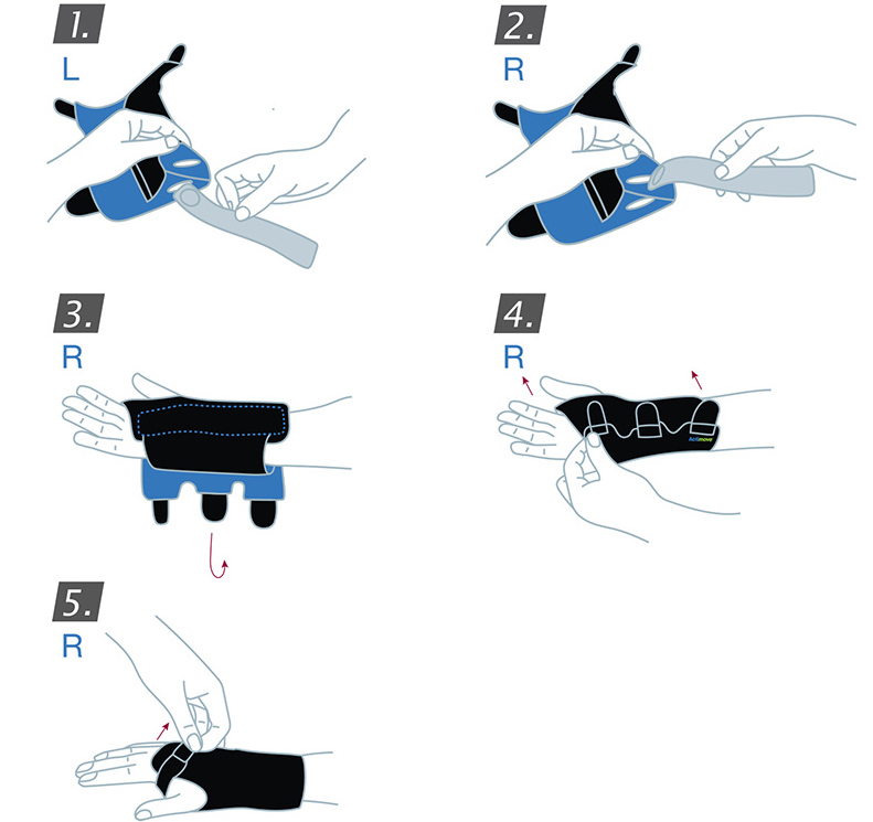 Application of the Actimove Children's Wrist Brace