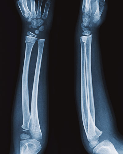 Buckle Fracture