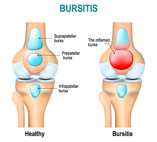 Healthy joint compared to one with bursitis