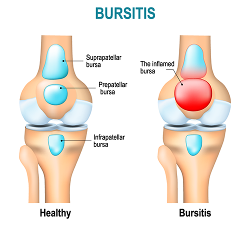 I Have Bursitis. So What Does That Mean?