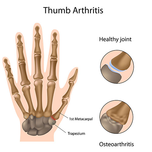 Arthrosis of the first cmc joint thumb arthritis