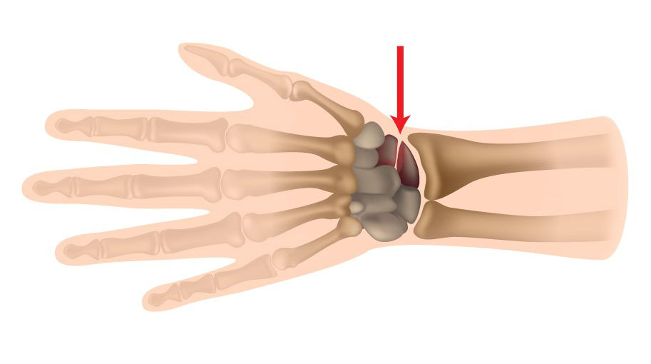 Ultimate Performance Ultimate Carpal Tunnel Wrist Brace Ultimate Performance Ultimate Carpal Tunnel Wrist Brace
